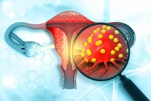 improves-the-probability-of-endometrial-hyperplasia