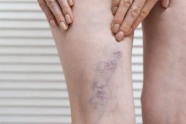 Varicose-veins